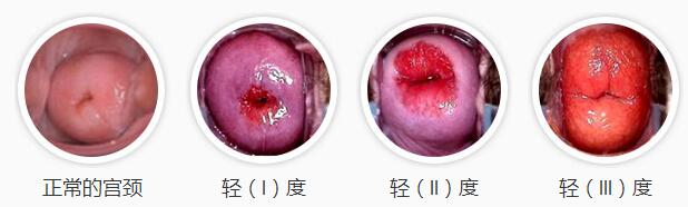 宫颈病变治疗