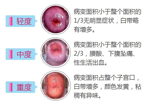 宫颈病变费用